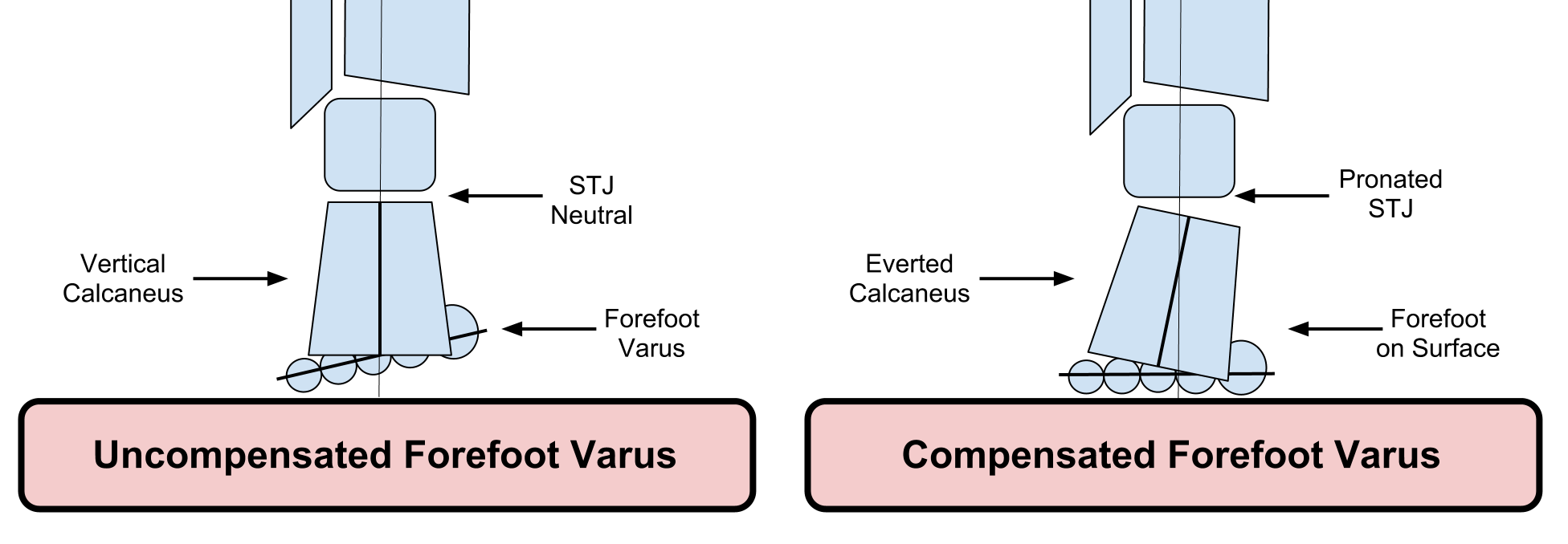 Over-Pronation