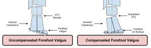 Forefoot Valgus